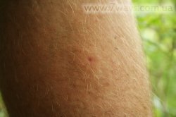 Место укуса пчелы